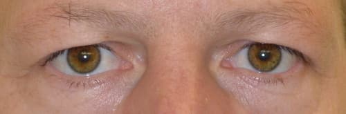 Szemhéjplasztika képek: Alsó lézeres szemhéjplasztika és felső lézeres szemhéjplasztika előtt és után - Szemhéjplasztika mindenkinek - Dr. Boros László